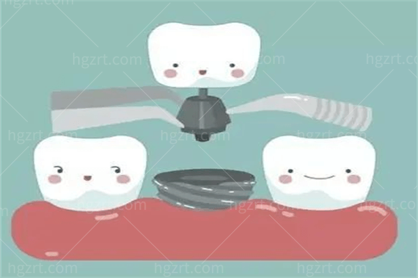 广州做种植牙好的医院排名，揭晓广州做牙齿好的口腔医院。