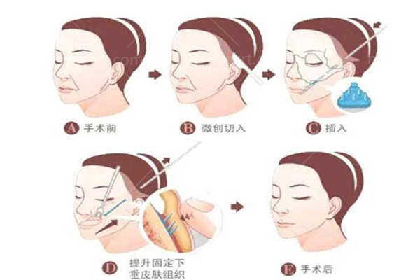 问：广州哪里做拉皮手术比较好？安排广州好的拉皮除皱医院