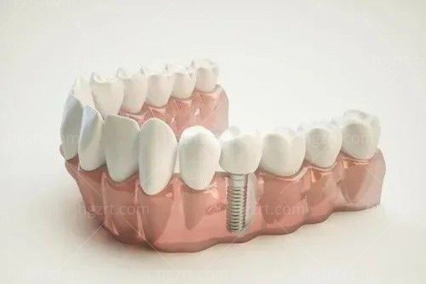 牙医说千万不要种植牙，关于种植牙常见问题