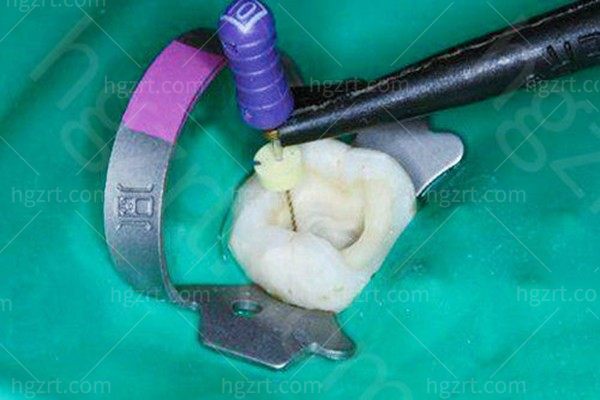 天津口腔医院根管治疗多少钱一颗?做过根管的牙能用几年?