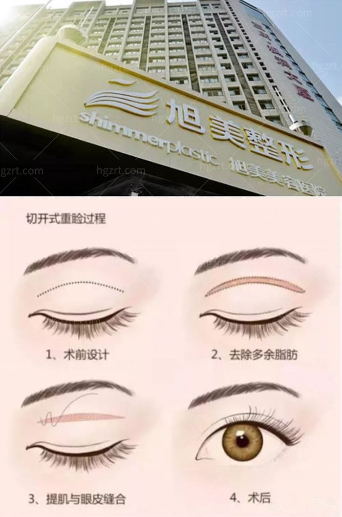 济南旭美美容医院全切双眼皮手术