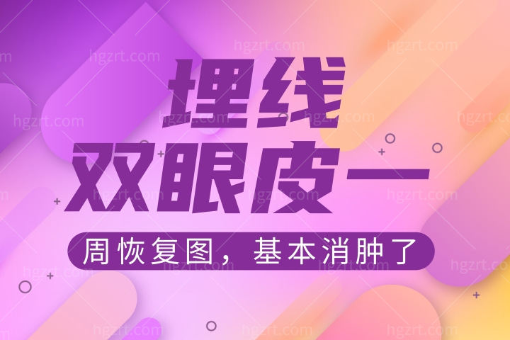 埋线双眼皮一周图，一周之后已经基本上消肿了