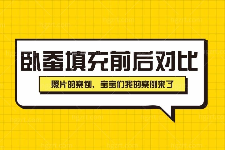 卧蚕填充前后对比照片的案例:卧蚕用什么填充好?眼袋肿成蛋袋了,急救消肿指南