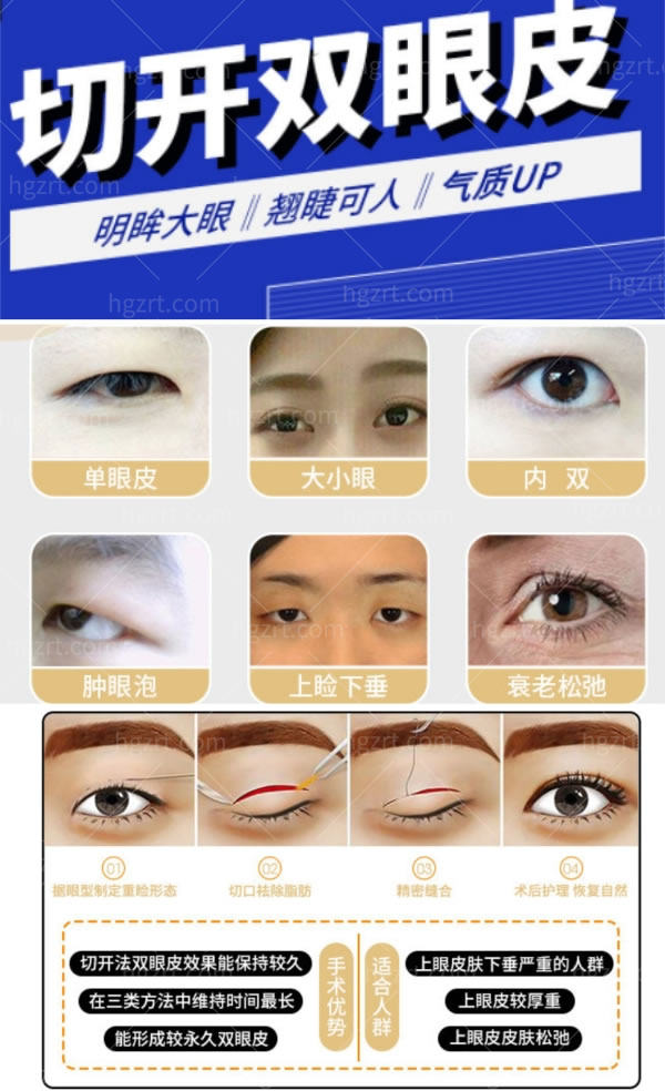 沈阳星和医疗美容-切开双眼皮