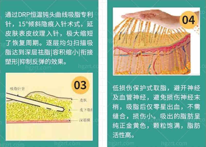 成都武侯蓉美和谐吸脂