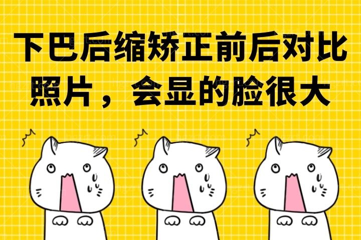 下巴后缩矫正前后对比照片，下巴短小后缩有时候会显的脸很大