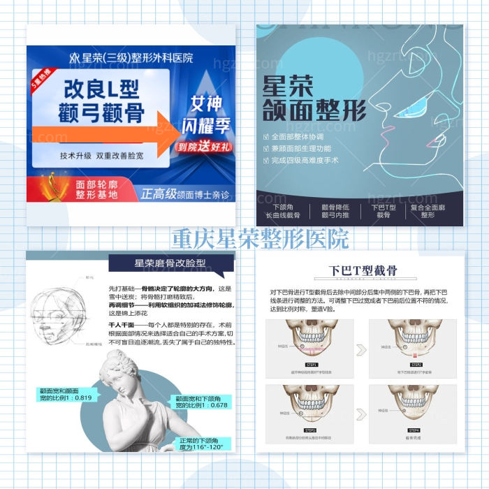 重庆星荣整形【颧骨颧弓】改脸型/颧弓内推/颧骨降低