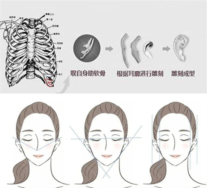 取肋骨的后遗症