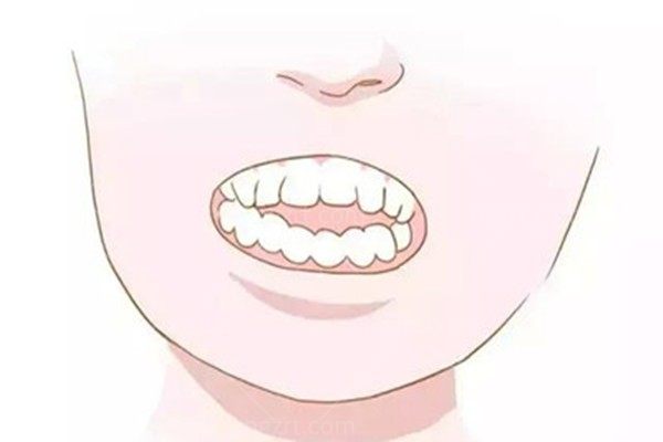 牙齿矫正后容貌变化，真的会变好看吗？