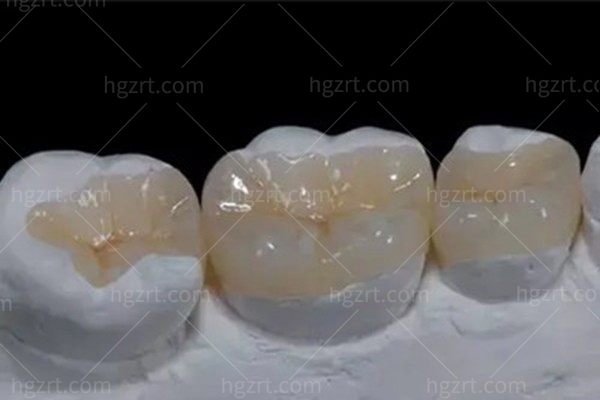 牙冠和嵌体修复哪个好?从各自优缺点看怎么补牙成效更好?
