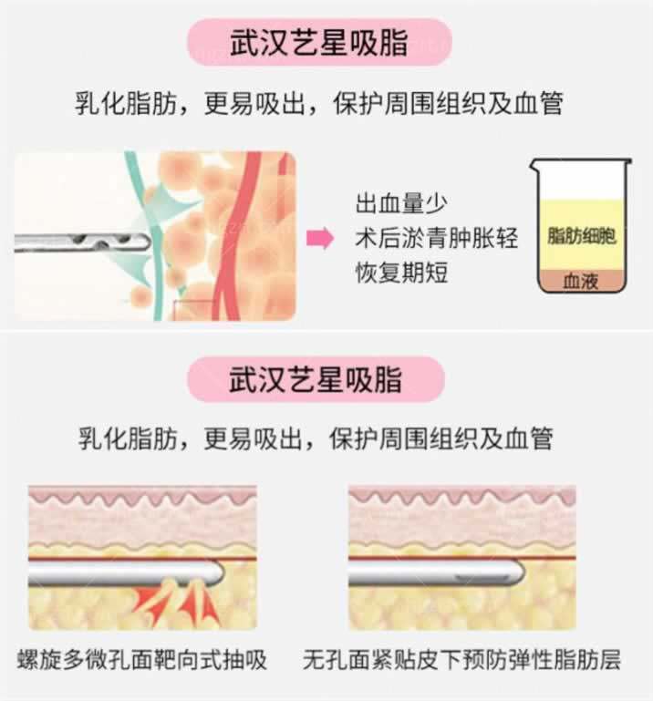 武汉抽脂哪家好