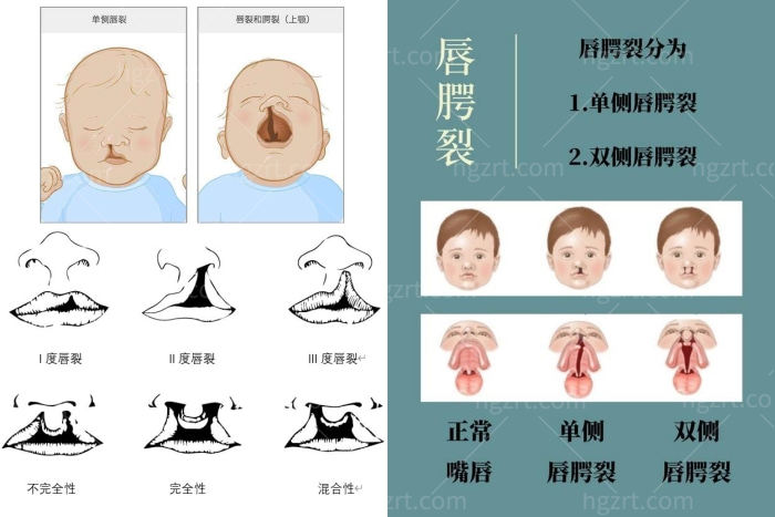 国内唇腭裂修复好的医院排名