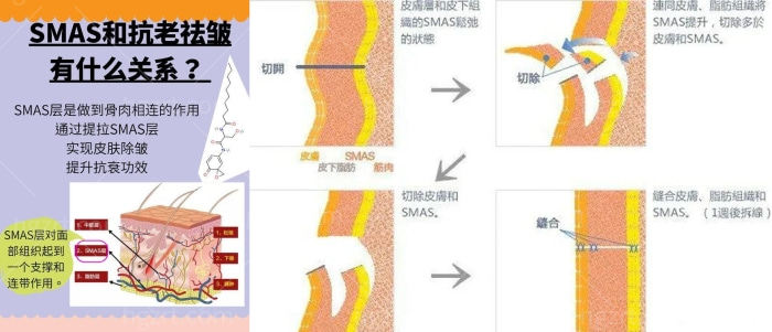 up!国内做面部提升好的的医生都有谁？让脸部提升紧致的方法非SMAS莫属！