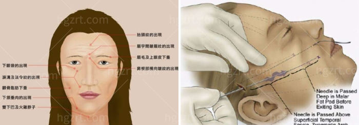拉皮手术.jpg