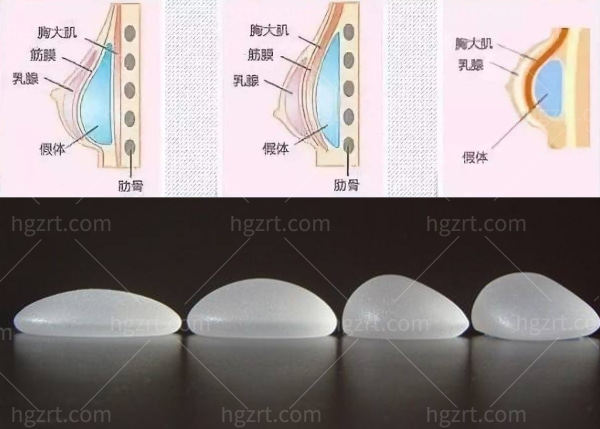 假体隆胸.jpg