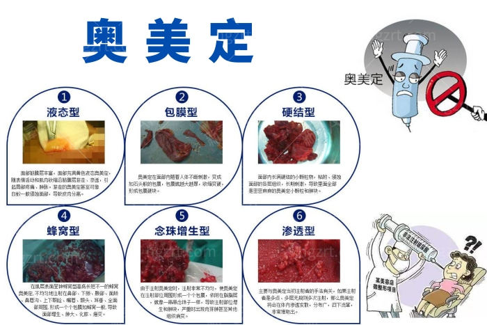 奥美定取出后胸部能到以前吗