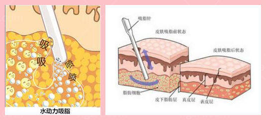 东莞抽脂哪家医院比较好 东莞十大正规整形医院