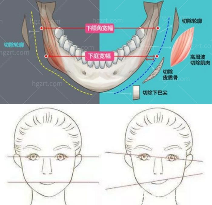 下颌角被切多了要修复该怎么做