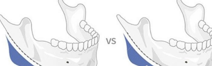 下颌角被切多了要修复该怎么做
