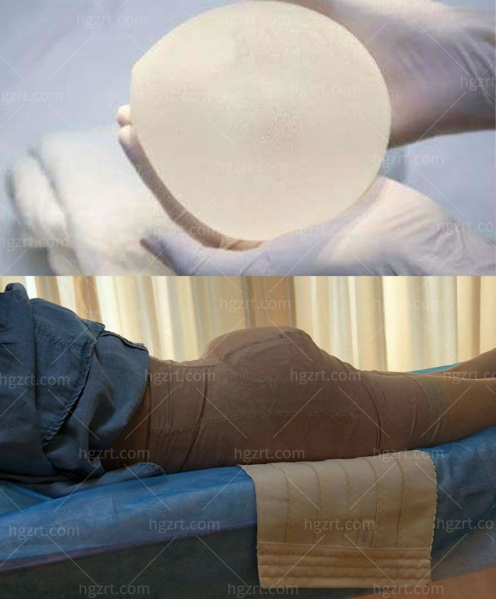 假体丰臀几天可以正常走路