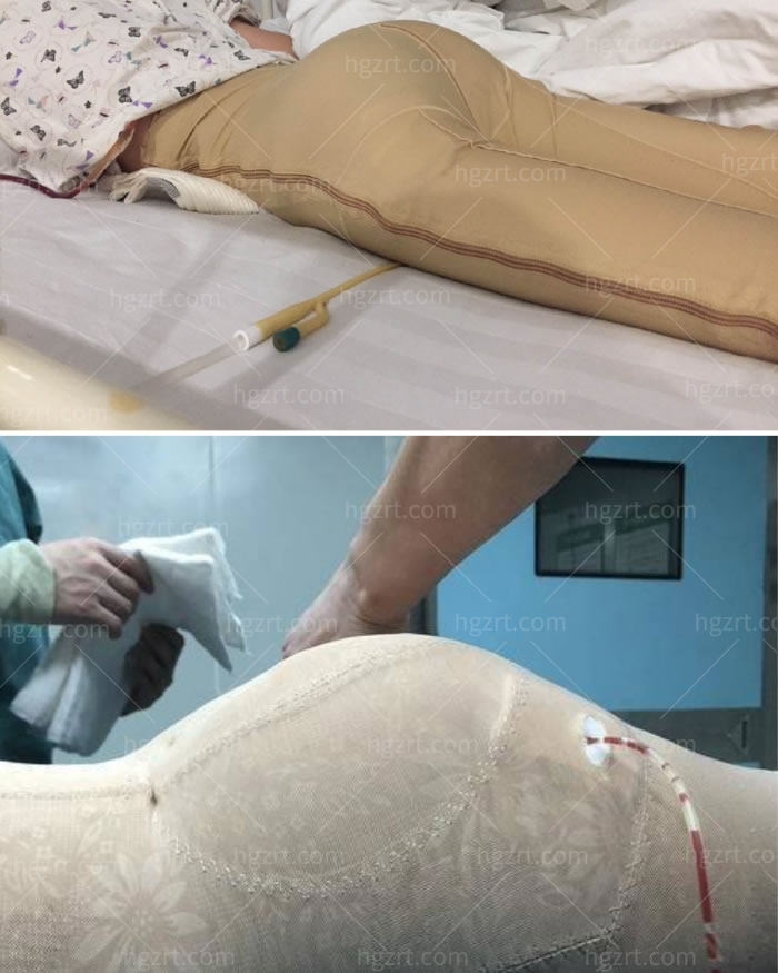 假体丰臀几天可以正常走路