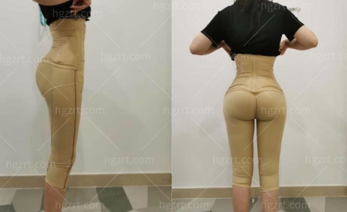 假体丰臀几天可以正常走路