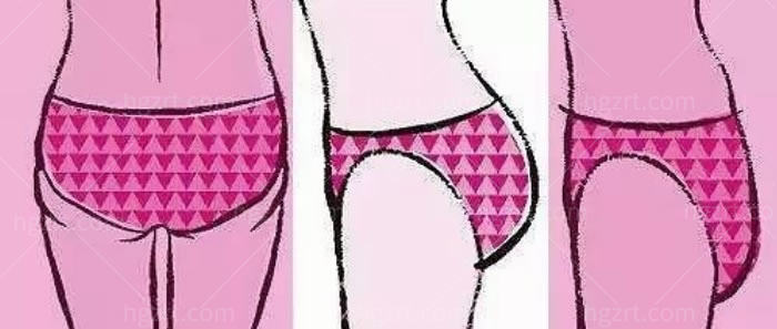 假体丰臀几天可以正常走路