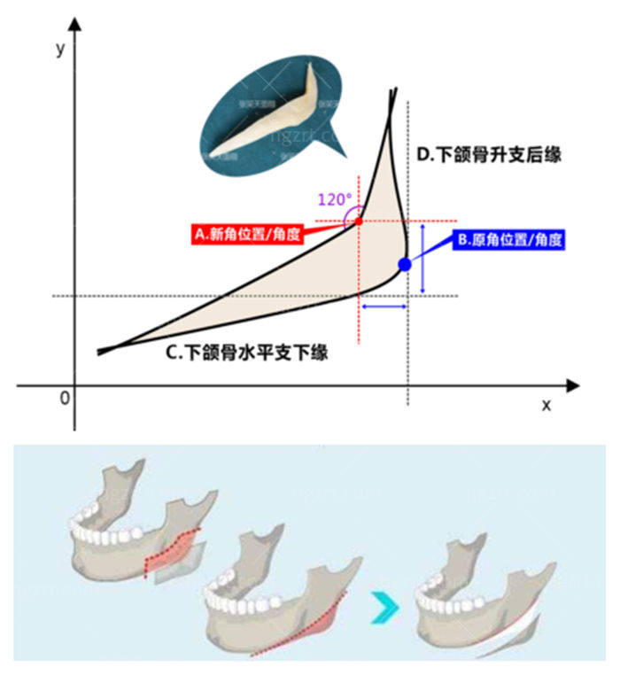 国内做下颌角手术好的医生医院