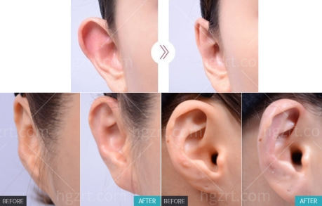 两只耳朵长得太贴后可以改善吗？