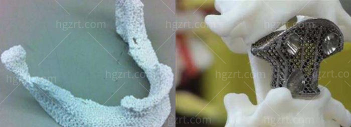 下颌角被切多了要修复该怎么做