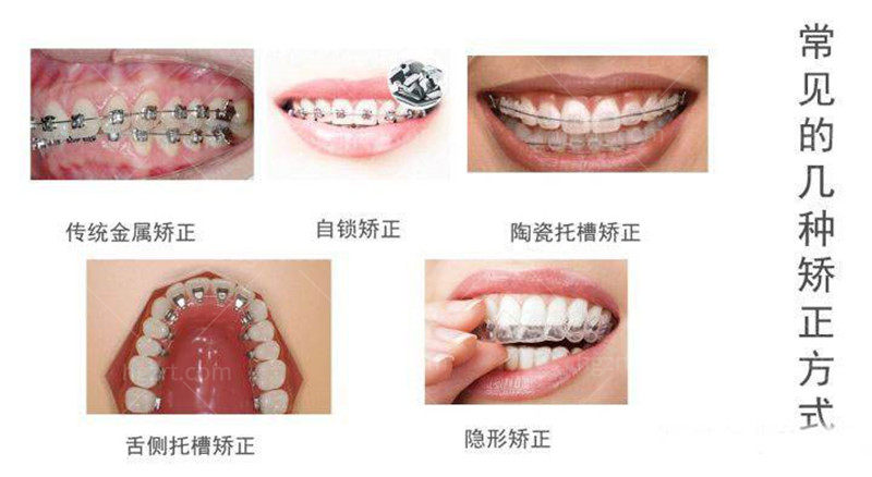 牙齿矫正的方式