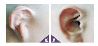 宝宝6种常见畸形耳朵图片照分析各种方案应对不同！