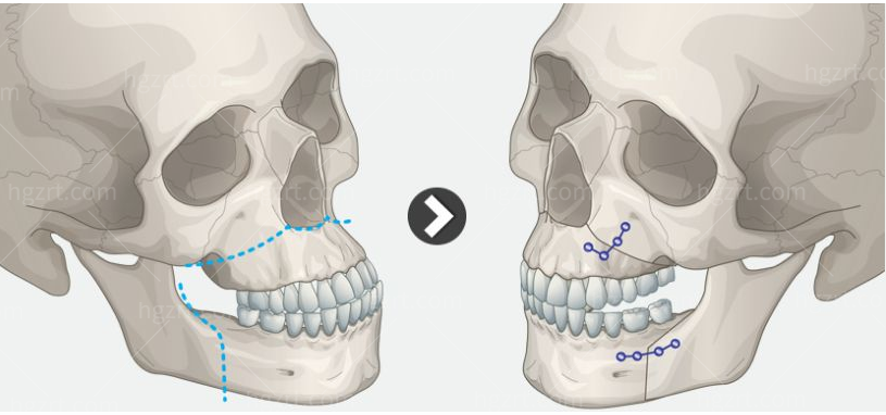 做双颚手术缩短中庭,真的可以变短脸吗？附上我的双颚手术经历