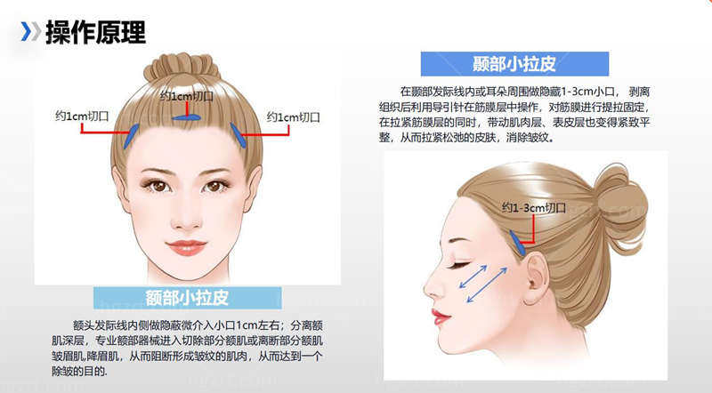 拉皮技术