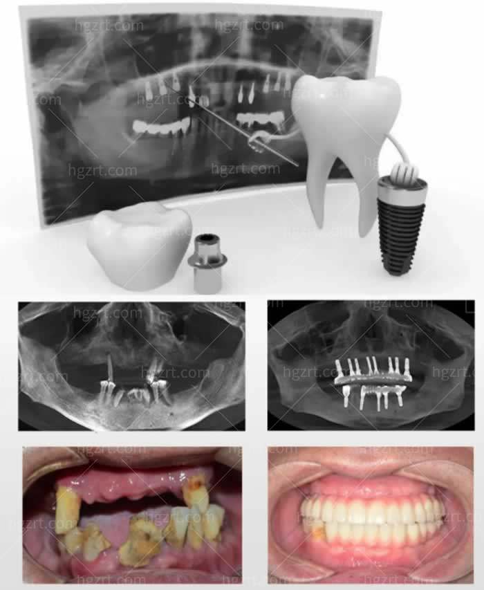 种植牙图