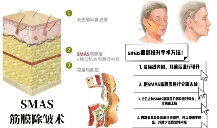 北京姚乃君医生的速提美手术怎么样？沉浸式除皱提升抗衰老紧致肌肤尽显年轻！