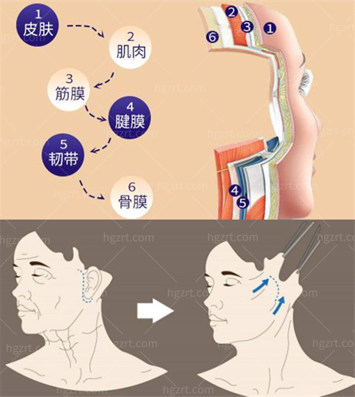 国内有靠谱的拉皮手术的医院吗？小切口<span style=