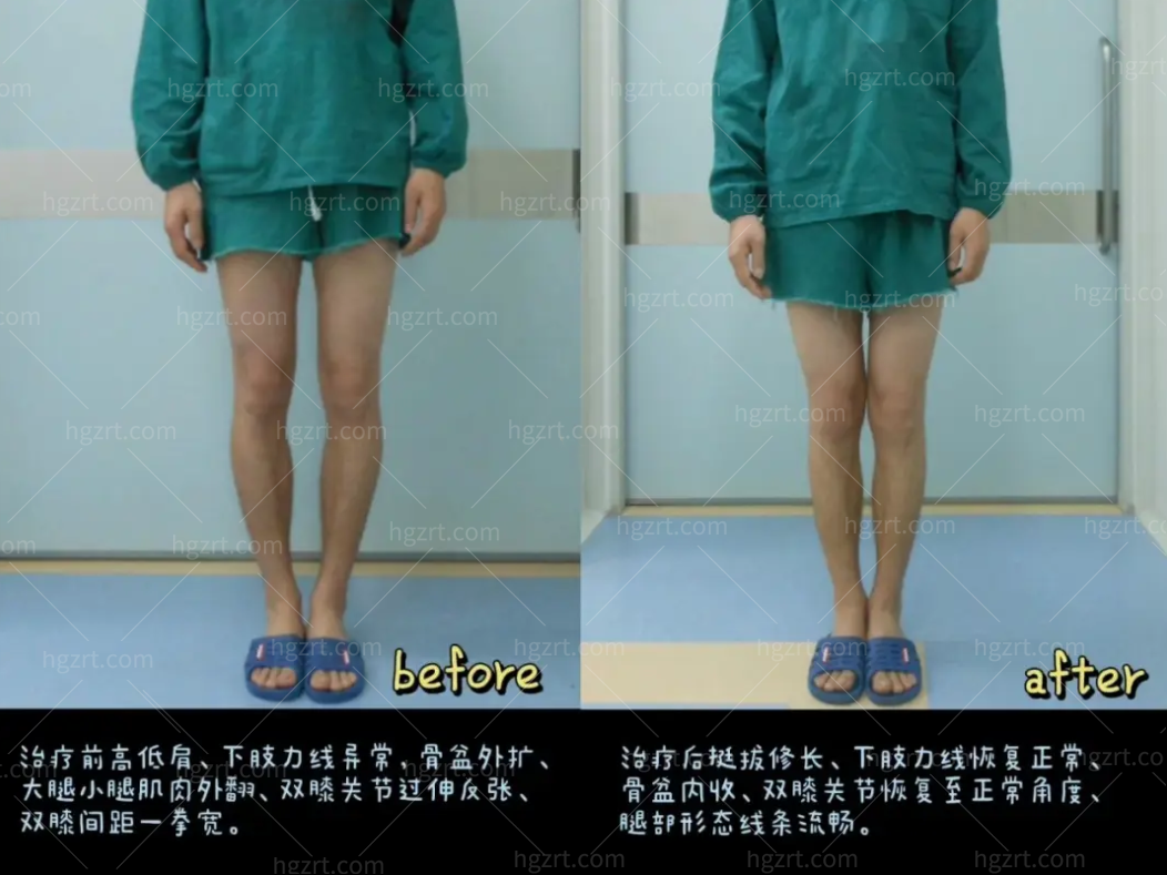 北京华意O型腿矫正多少钱？家人们你猜o型腿怎么矫正？