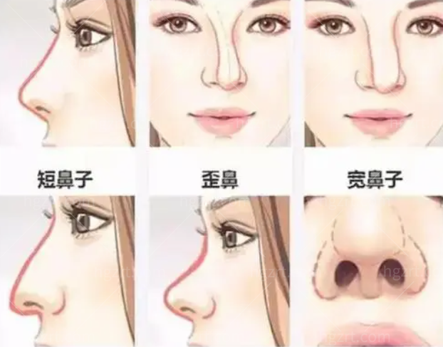 放假做了隆鼻38800，在深圳艺星整容医院做的，你觉得划算吗？