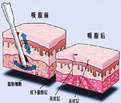 海峡美容医院四月惊喜，偷偷告诉你腰腹吸脂7800太可了吧！