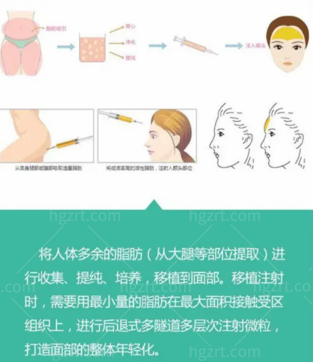 周末在邢台伊美花了6800做了脂肪填充，还有多项优惠让我心动