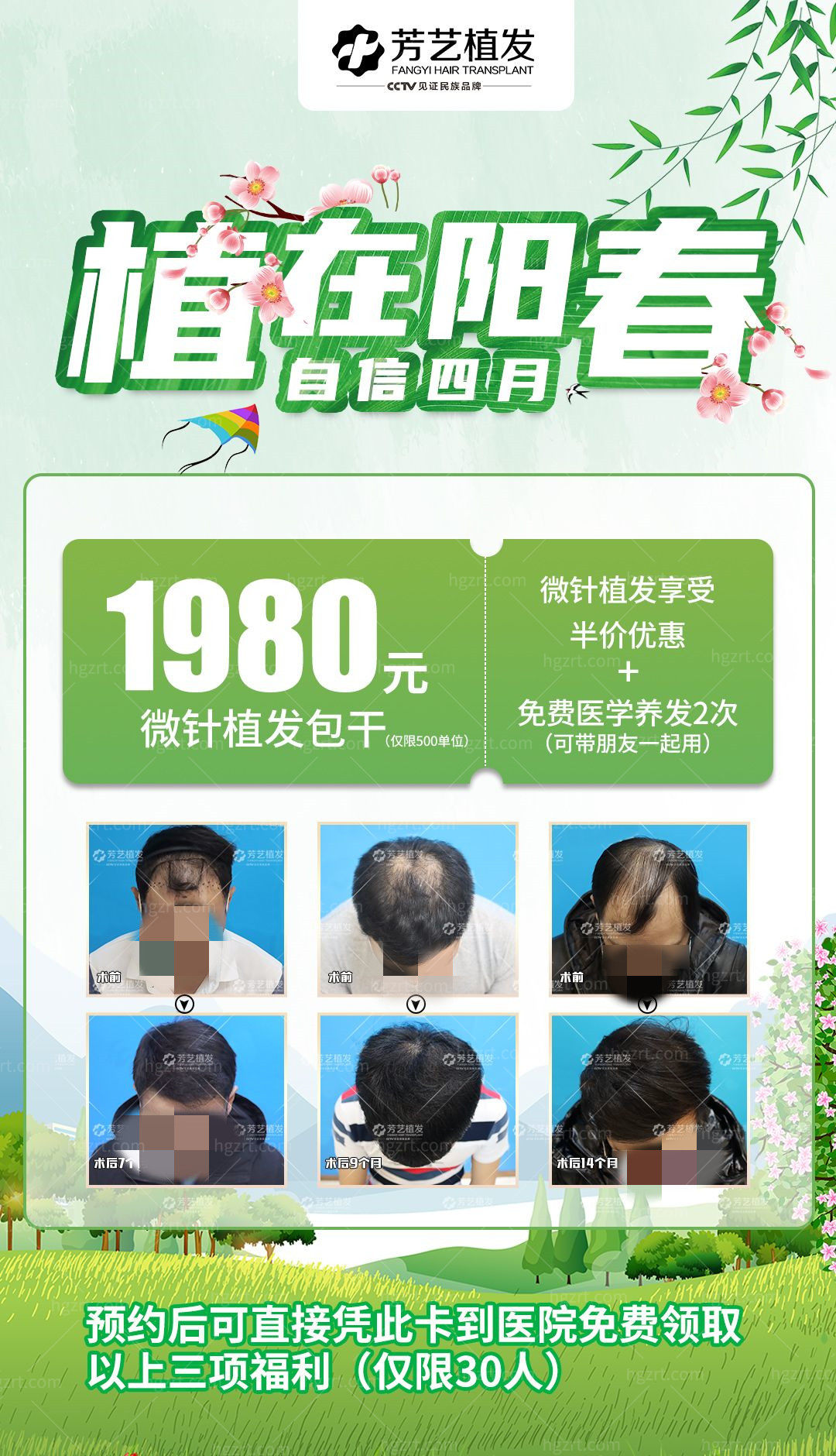 天啊撸！郑州芳艺植发医院技术太好了微针植发500单位才1980元起绝绝子啊！