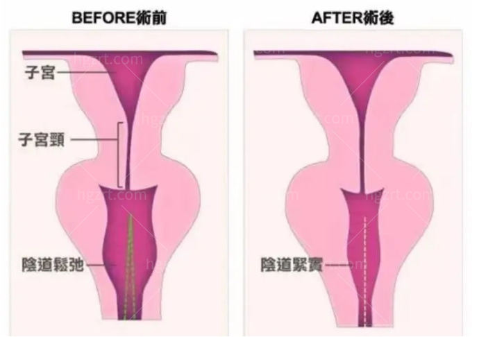 4D生物束带紧缩术哪里可以做？推荐西安国医非手术操作恢复阴道紧致！