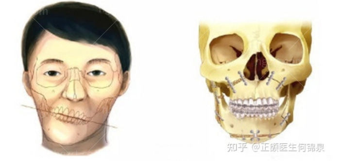广州做正颌手术比较好的医院！还有医生推荐和正颌手术费用！