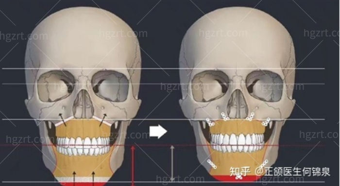 广州做正颌手术比较好的医院！还有医生推荐和正颌手术费用！