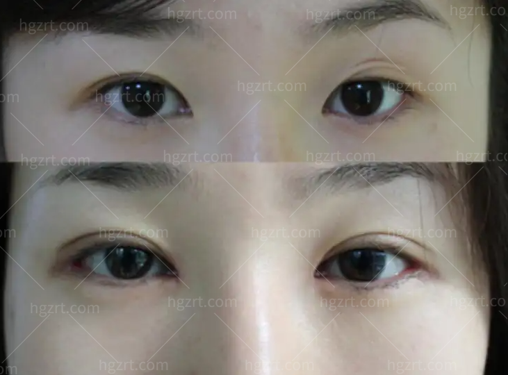 闺蜜去上海杨亚益医生双眼皮修复手术做得怎么样？偷偷分享杨亚益双眼皮体验