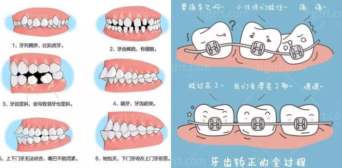 矫正牙套软的好还是硬的好？两者区别在哪里？