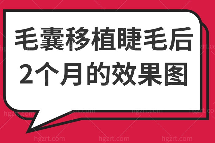 毛囊移植睫毛后2个月的图