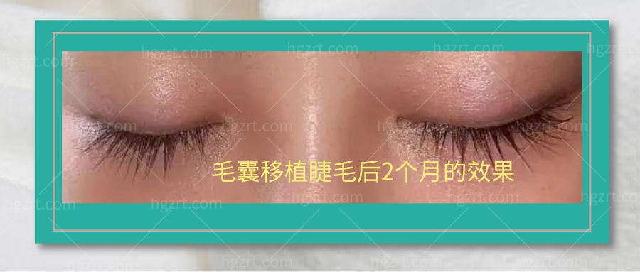 毛囊移植睫毛后2个月的图