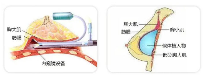 西安隆胸哪里好？西美整形外科全新的内窥镜隆胸技术了解下！